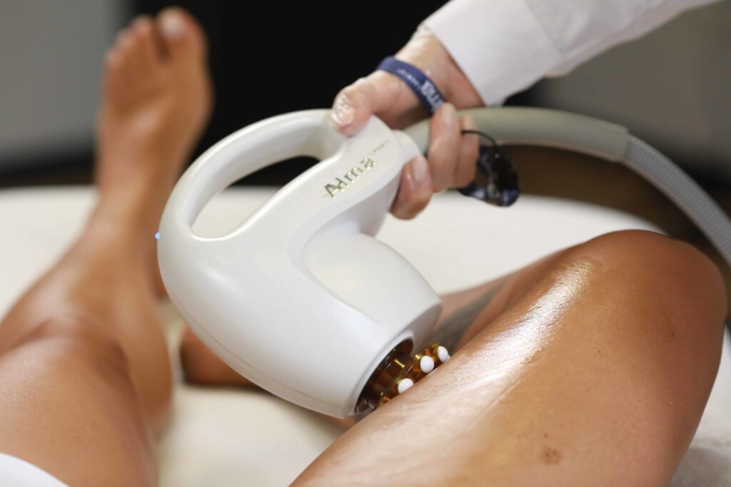 alma accent prime leg fat reduction and skin tightening